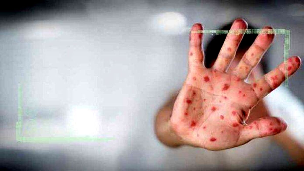 پاسخ سازمان جهانی بهداشت به سوالات درباره آبله میمونی